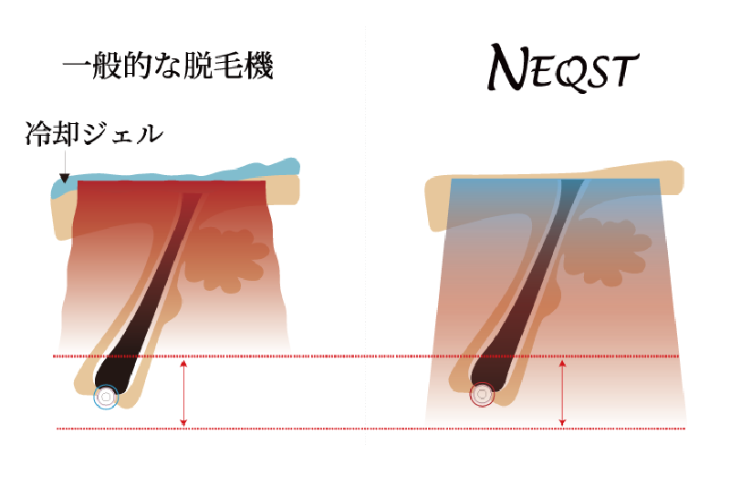脱毛資料画像